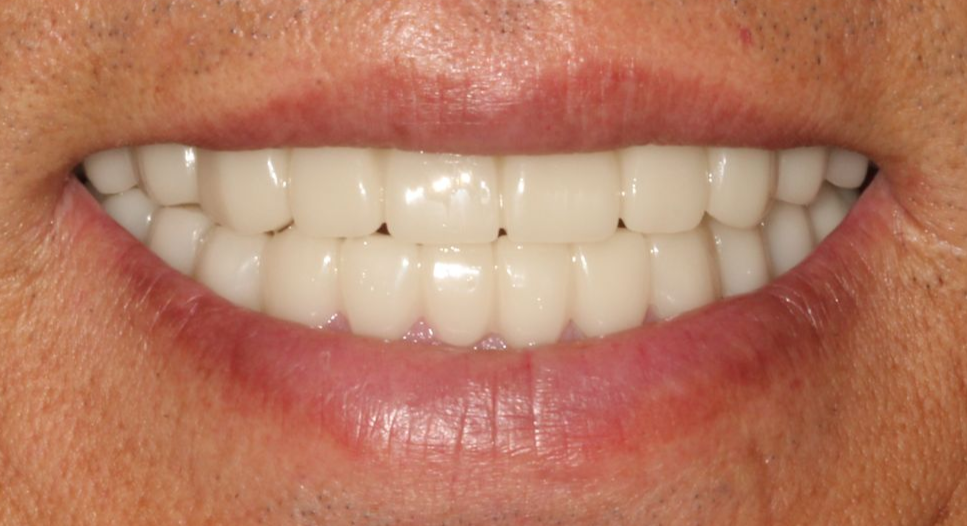 A close up of a person 's teeth with porcelain crowns.