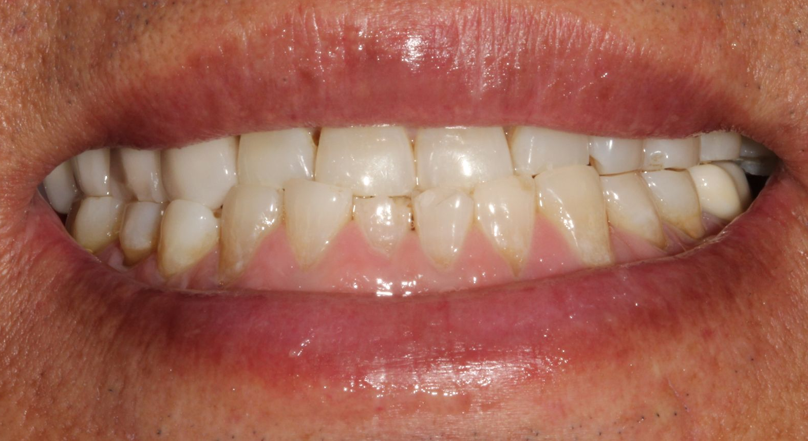 A close up of a person 's teeth with a broken tooth.
