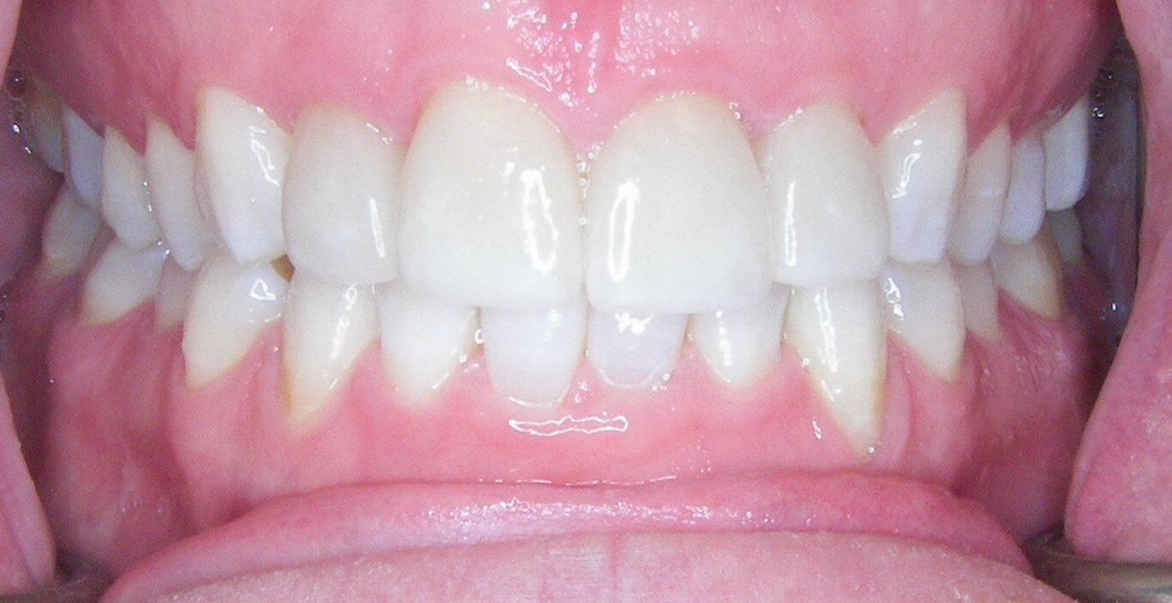 A close up of a person 's teeth with porcelain crowns.