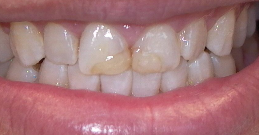 A close up of a person 's teeth with a broken tooth.