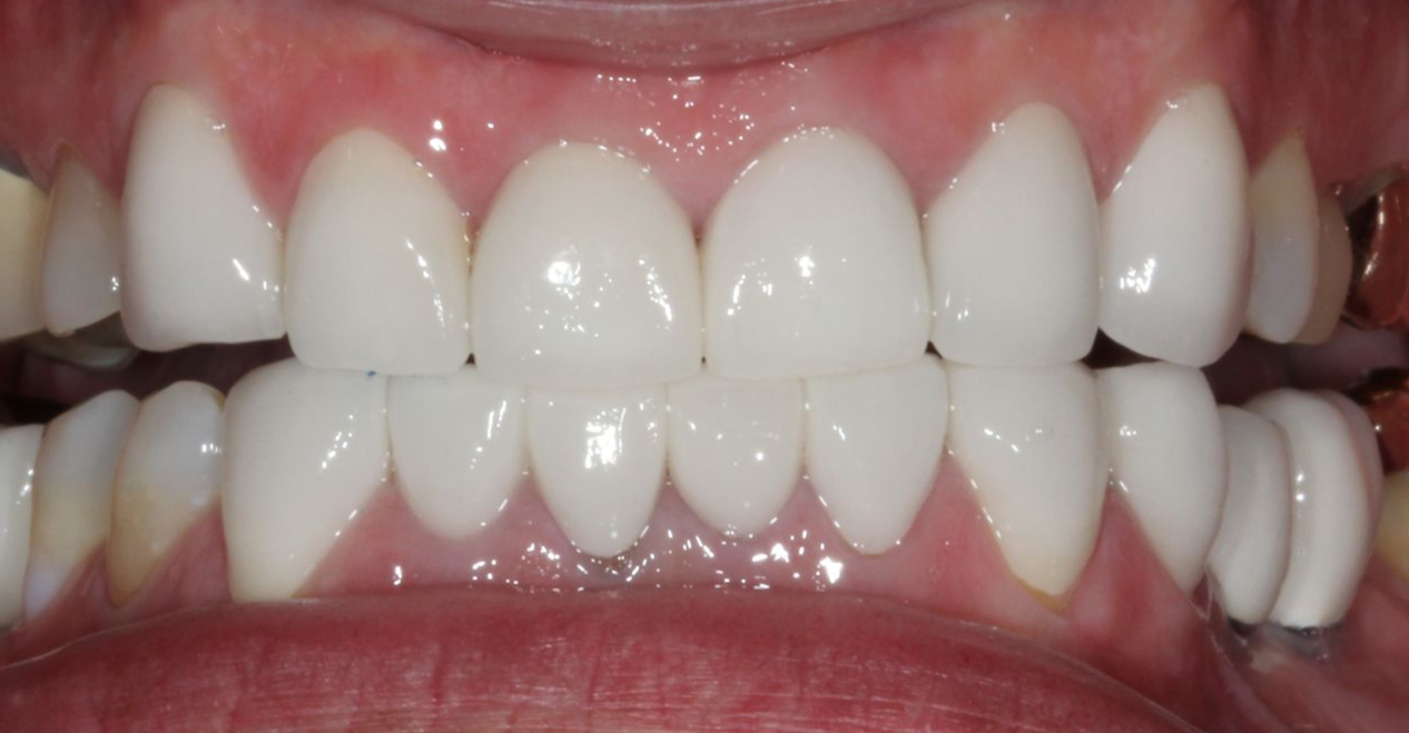 A close up of a person 's teeth with porcelain crowns.