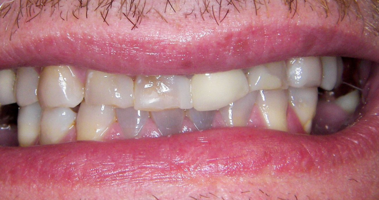 A close up of a person 's teeth with a broken tooth.