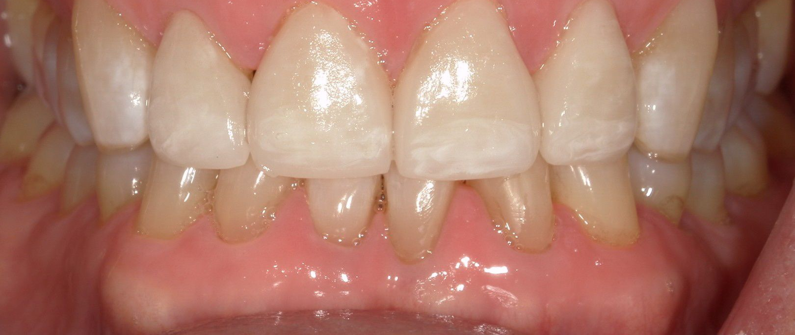 A close up of a person 's teeth with porcelain crowns.
