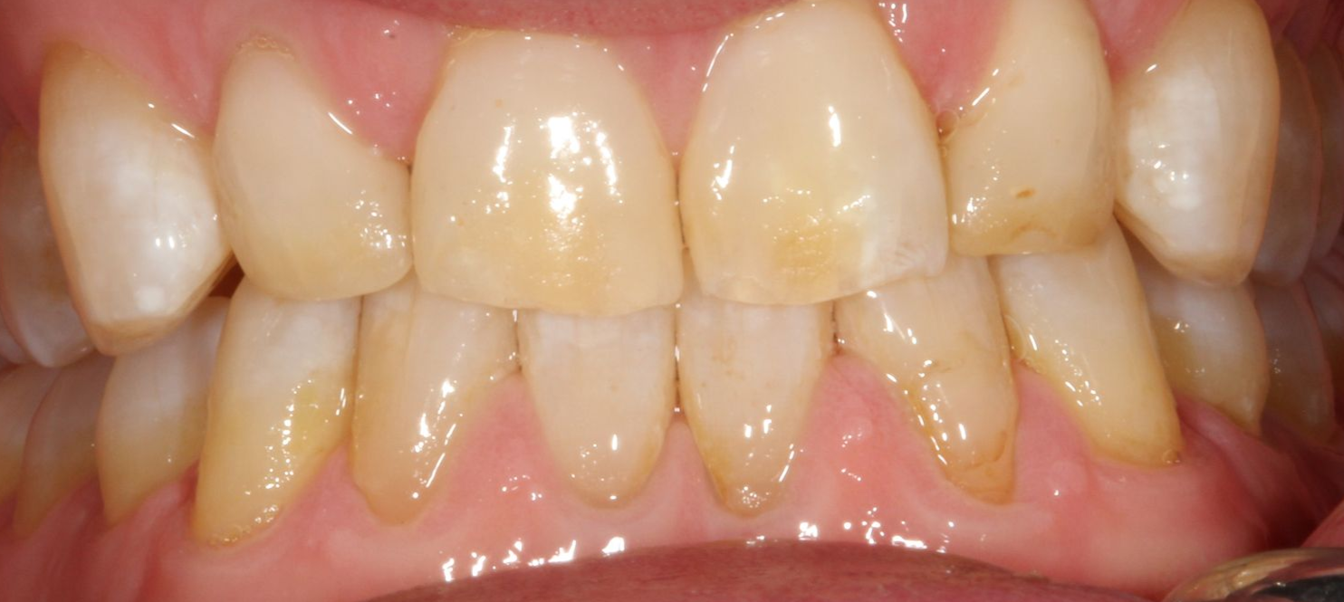A close up of a person 's teeth with a broken tooth.