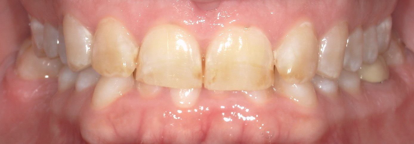 A close up of a person 's teeth with a broken tooth.