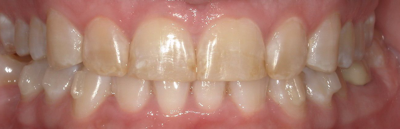 A close up of a person 's teeth with porcelain crowns.