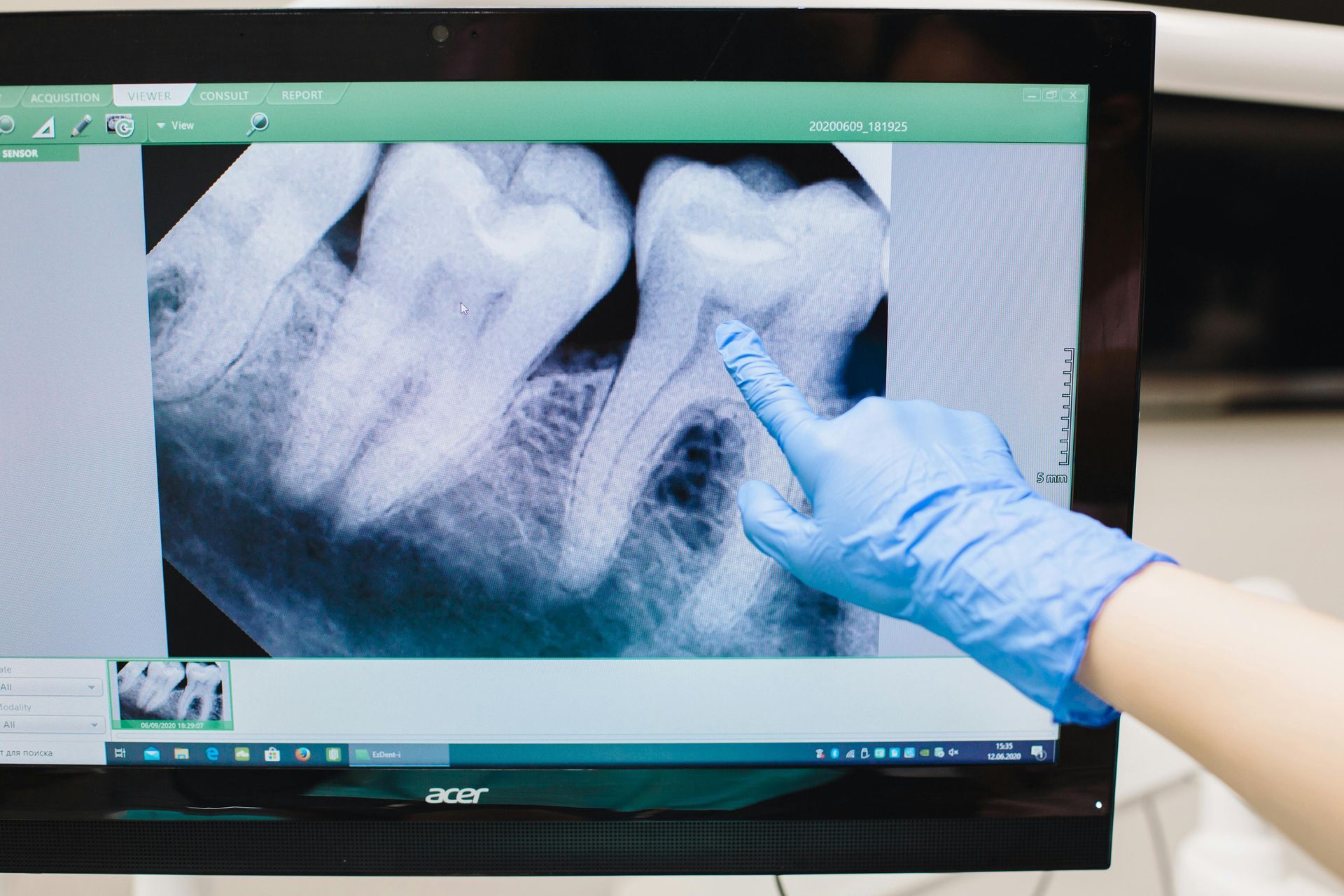 A dentist's gloved hand points to a tooth on an X-ray displayed on a computer screen.
