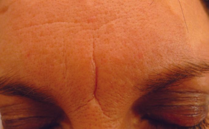 Een close-up van het voorhoofd van een vrouw met haar ogen dicht.