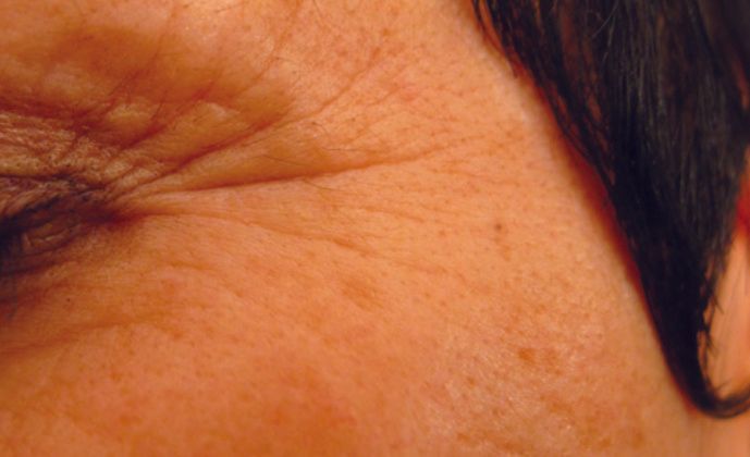 Een close-up van het gezicht van een vrouw met rimpels.