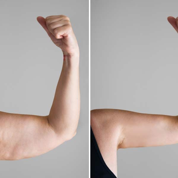 A before-and-after photo of a woman's arm with amazing body contouring results