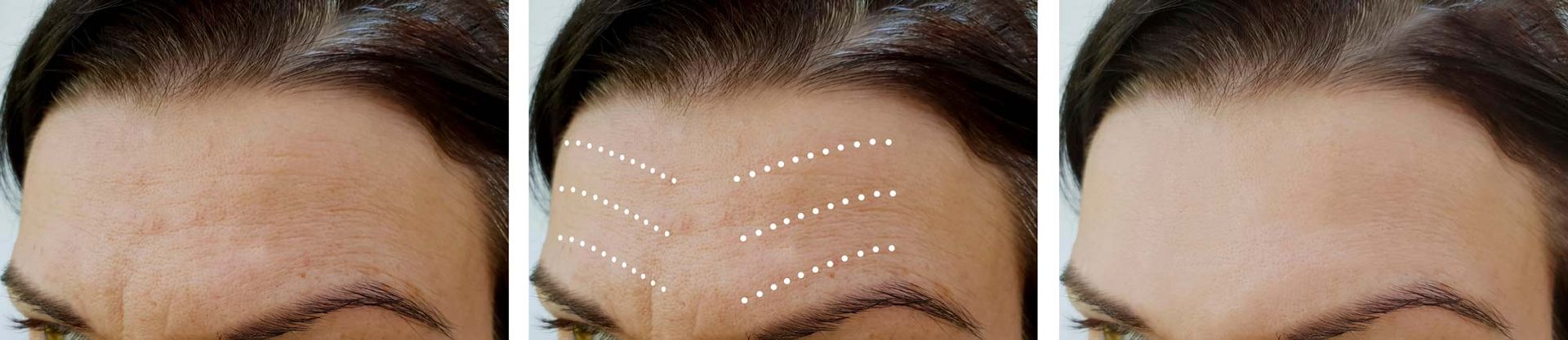 A woman 's forehead before and after Botox injections for frown lines.