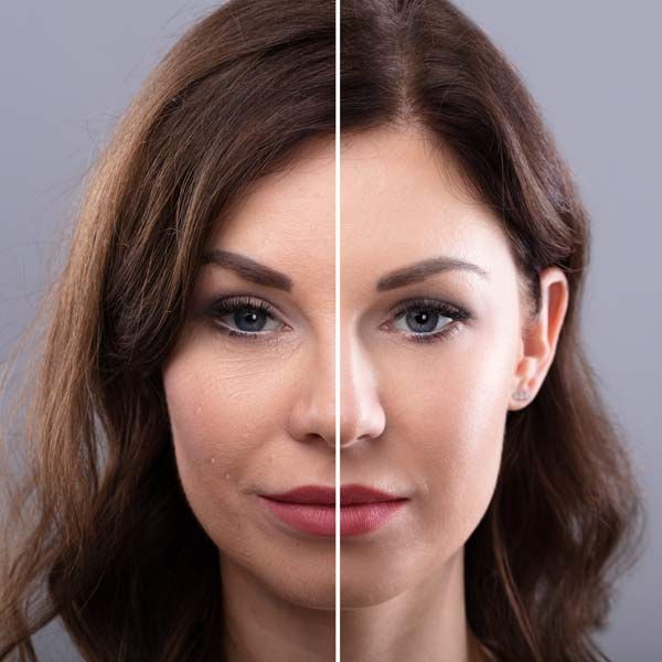 A before-and-after photo of a woman's face after dermer Fillers Treatment