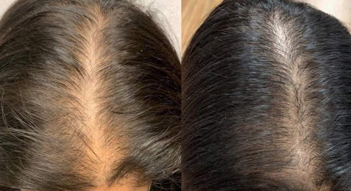 A before-and-after photo of a woman's hair after Medical Hair Regrowth NJ and NYC at Victory Medical Institute