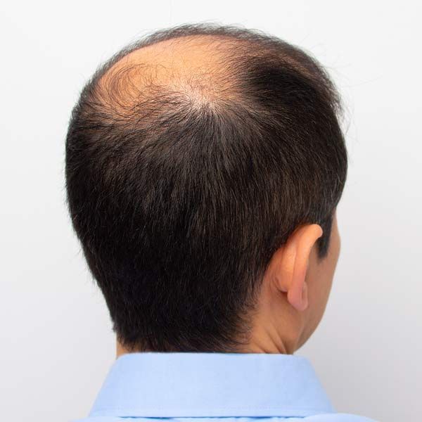 Ideal Candidates for Hair Rejuvenation with Plasma-Rich Platelets in Morris Plains New Jersey and Manhattan New York