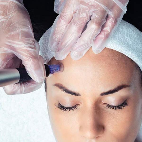 A woman is getting a Medical Microneedling with Platelet-Rich Plasma (PRP) Treatment
