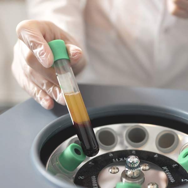 A person is holding a test tube for Achieve Radiant Skin with Medical Microneedling and Platelet-Rich Plasma in Morris Plains New Jersey and Manhattan New York