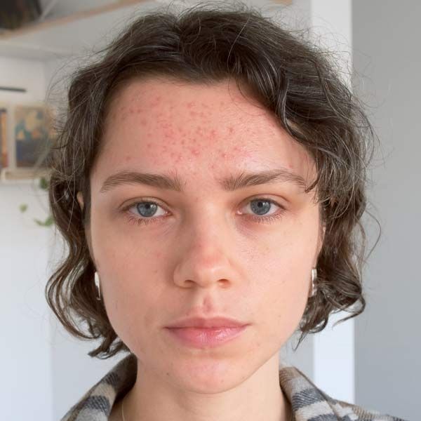 A woman with acne on her face before Morpheus8 Microneedling Treatment