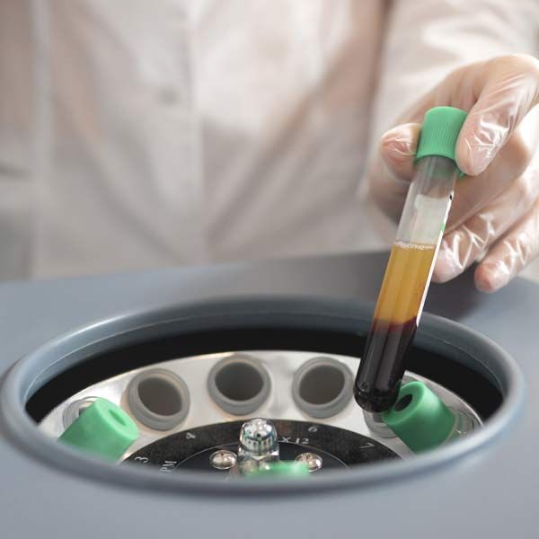 A person is holding a test tube with Platelet-Rich Plasma with a green cap