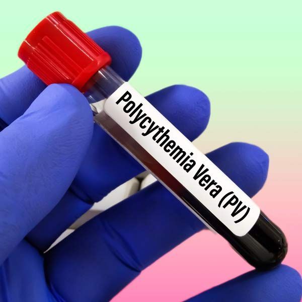 A person in a blue glove is holding a test tube of polycythemia vera