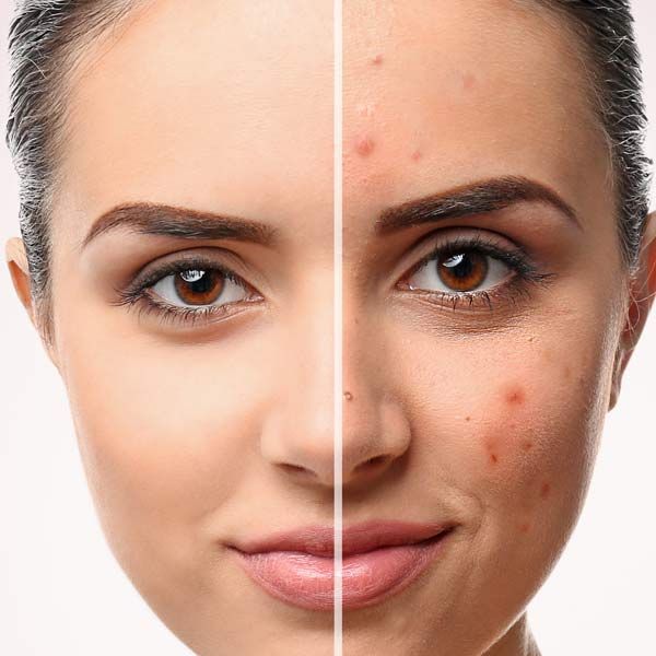 A before-and-after picture of a woman's face with acne. Medical Skin Tightening with Morpheus8 in Morris Plains, New Jersey, and Manhattan, New York