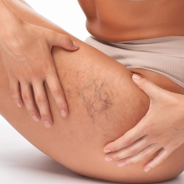 A woman 's leg with varicose veins on it needing Spider Vein Removal Treatments