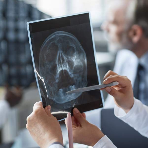 A doctor is holding an X-ray of a skull, evaluating Traumatic Brain Injury (TBI) and Concussion