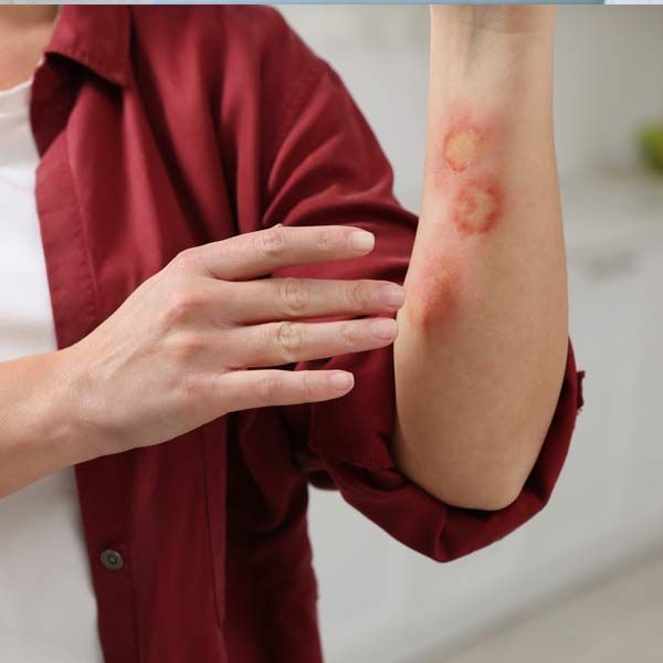 A woman in a red shirt has a burn on her arm needing treatment for Skin Conditions, Burns & Chronic Wounds