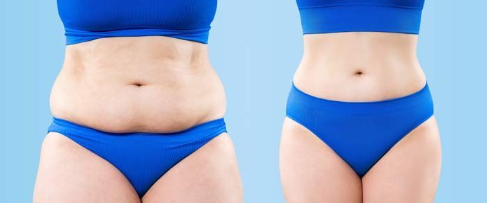 A woman in blue underwear is shown before and after losing weight after participating in Medical Weight Loss NJ and NY at Victory Medical Institute.