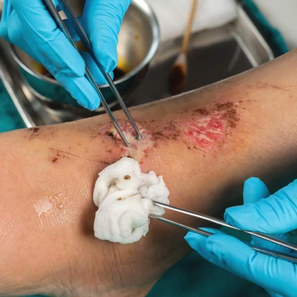 Doctore treating patient with Wound Care