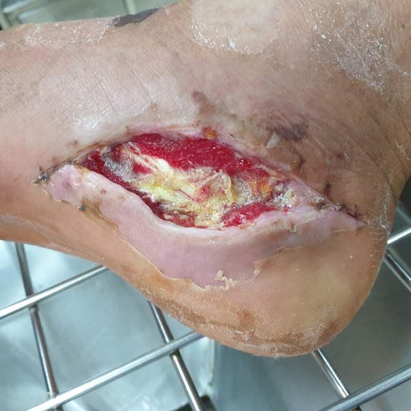 Infected Wound on Patient's Foot. Infected Wound Needing Advanced Regenerative Orthobiologic Tissue Repair Therapy Serving Patients in Morris Plains New Jersey and Manhattan New York