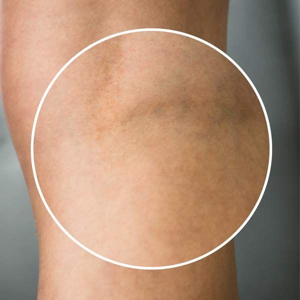 After Spider Vein Removal Treatments at Victory Medical Institute