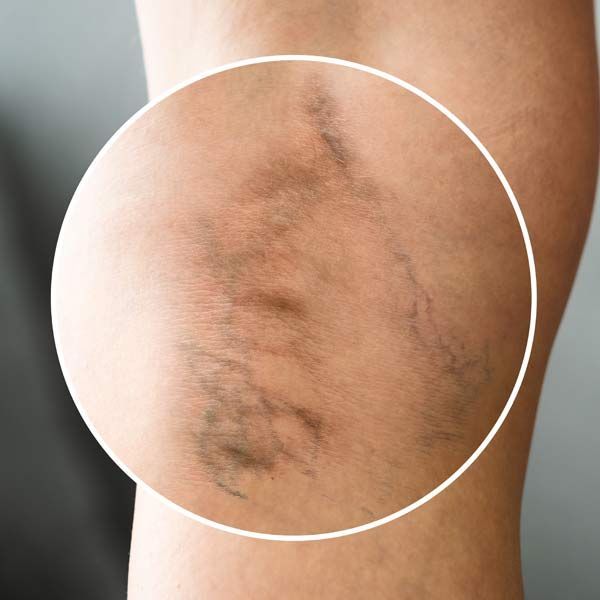 Before Spider Vein Removal Treatments in Morris Plains, New Jersey, and Manhattan, New York