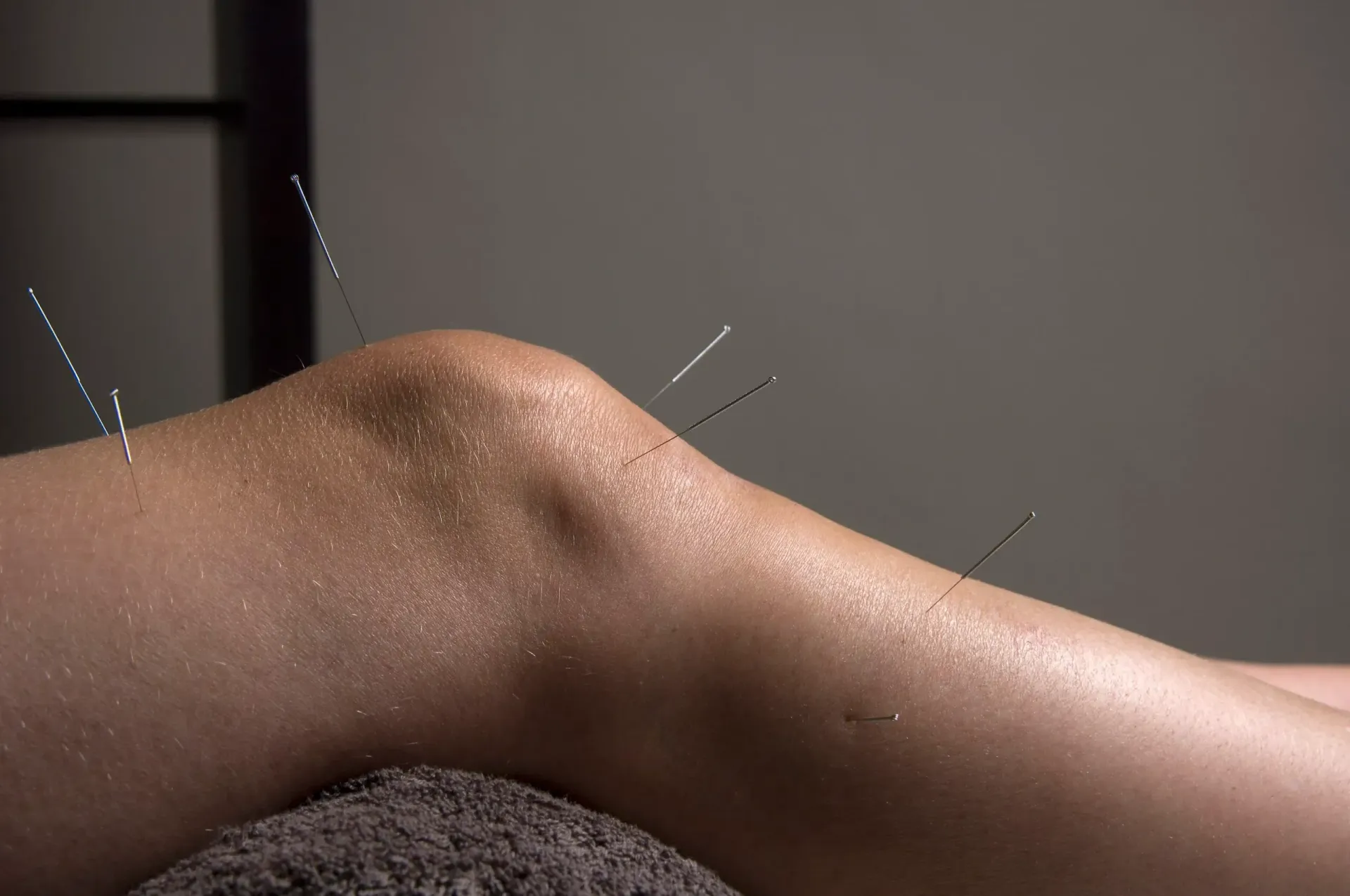 Knee with multiple acupuncture needles inserted, on a gray upholstered surface.