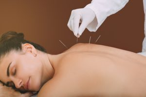 Woman receiving acupuncture treatment on her back; needles inserted, therapist's hand visible.