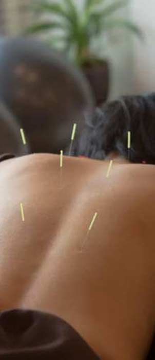 A person's back with acupuncture needles inserted.