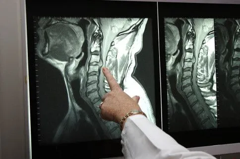 A person pointing at an MRI scan of a neck and spine; medical setting.