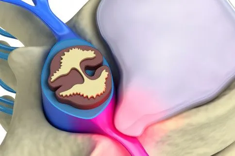Cross-section of spine showing spinal cord compressed, causing red pain area. Bone, nerves, and spinal disc also visible.