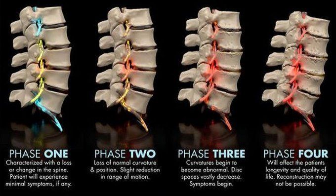 Arthritis Treatments