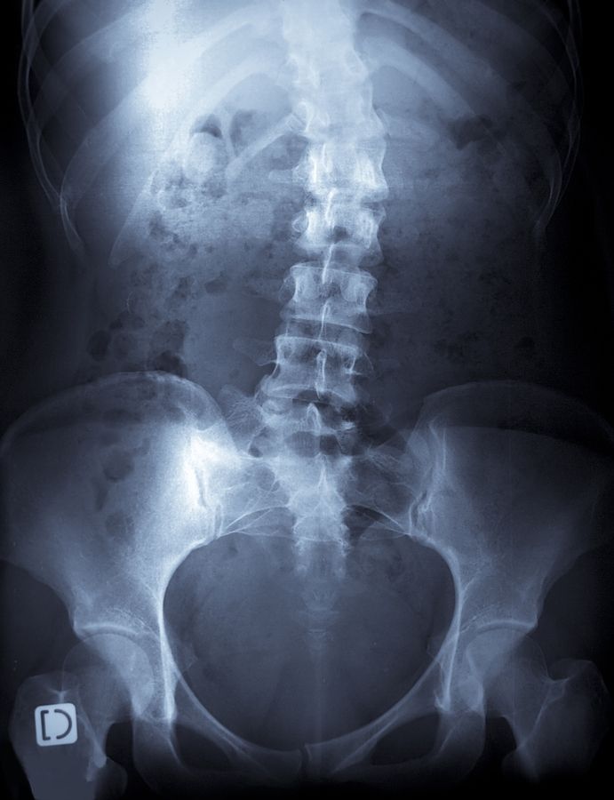 An X-ray of a Person With Scoliosis