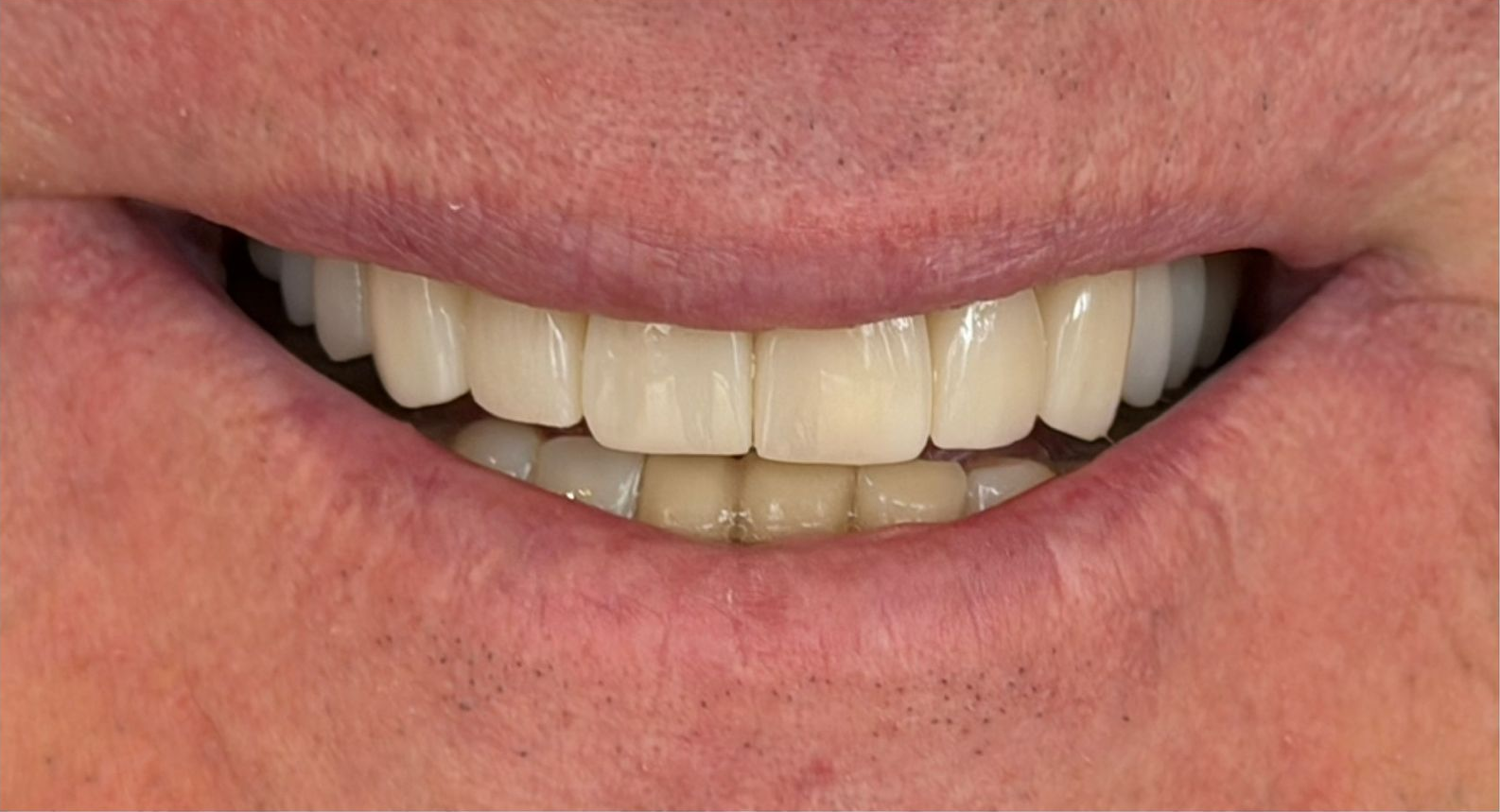 A close up of a man 's mouth with his teeth showing.