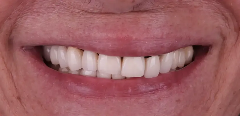 A close up of a man 's mouth with missing teeth.