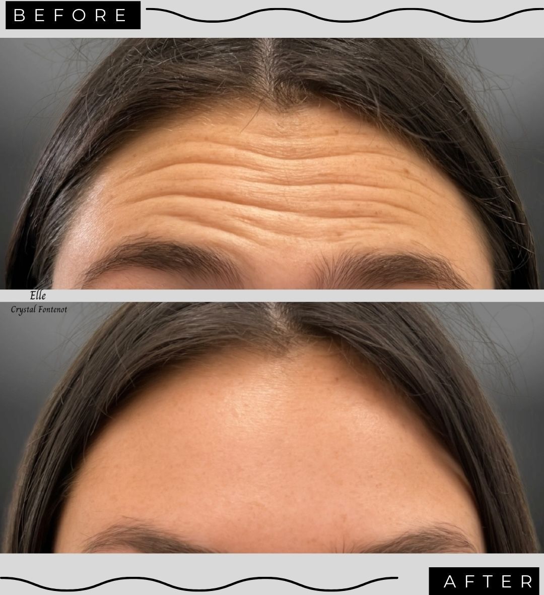 Forehead wrinkle relaxer results in Lafayette, Louisiana showing smoother skin after treatment.