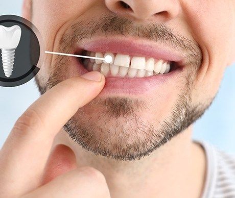 A man with a beard is holding a dental implant in his mouth.