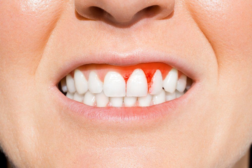 Woman With Bleeding Gums — Maitland Dental Care In Maitland NSW