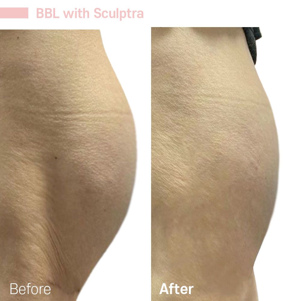 A before and after photo of a woman 's torso with sculptra