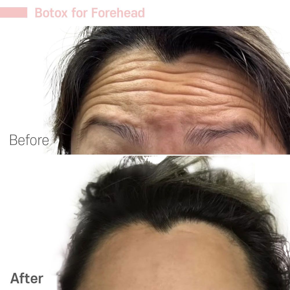 A before and after photo of a woman 's forehead with botox.