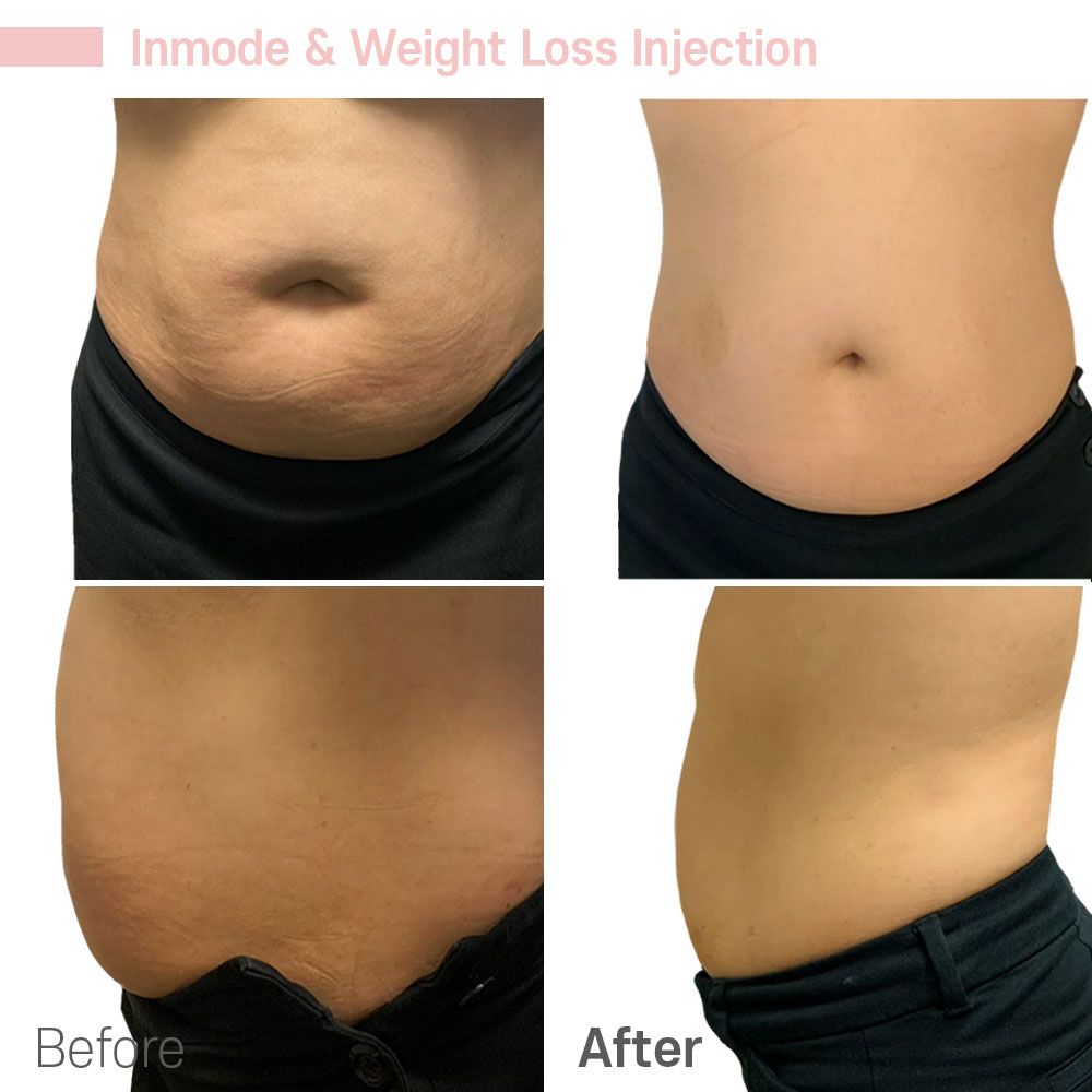 A woman 's stomach before and after a weight loss injection