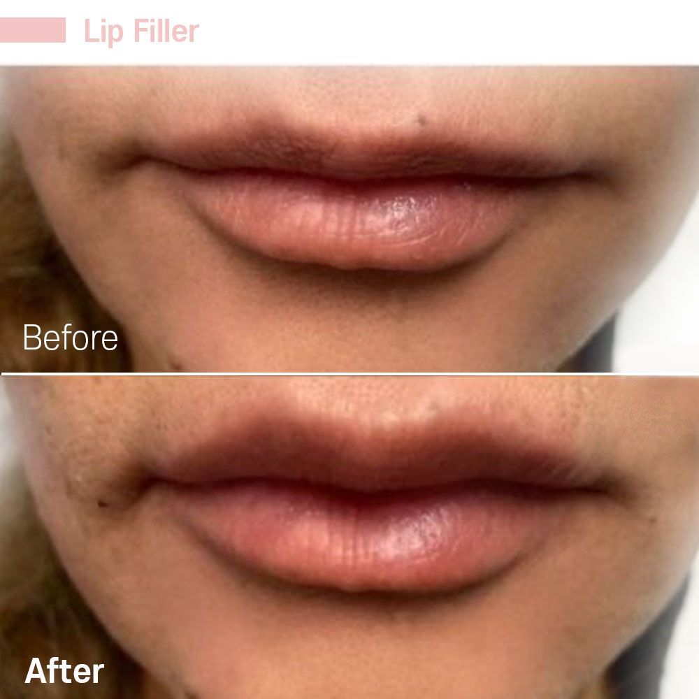 A before and after picture of a woman 's lips with lip filler