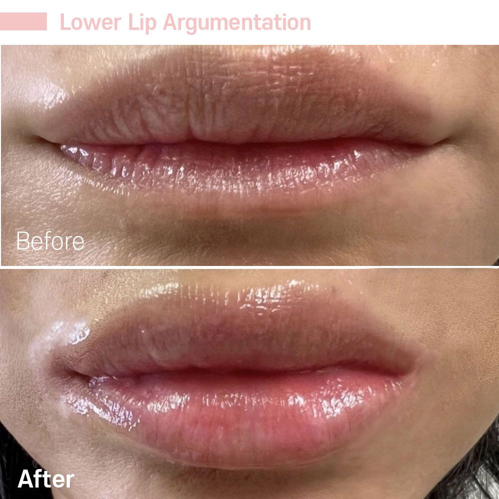 A before and after photo of a woman 's lips.