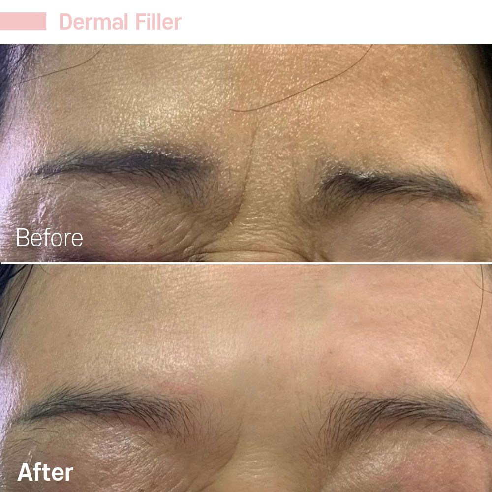 A before and after photo of a woman 's forehead with dermal filler.